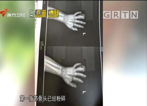 4岁男孩手指被这种健身器械所伤，导致截肢！很多小区都有