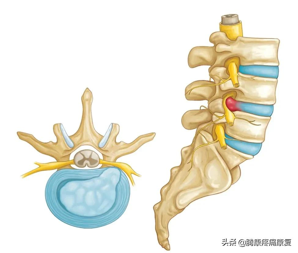 掌握这七个动作，改善你的腰椎间盘突出